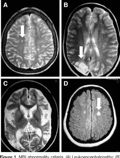 Figure 1 From Brain Magnetic Resonance Imaging Abnormalities In Adult