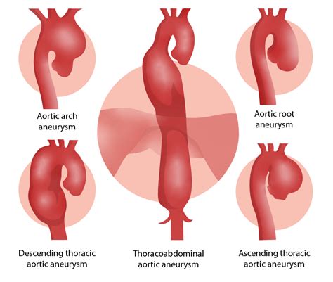 Thoracic Aortic Aneurysms Clinical Concise Medical Knowledge