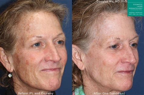what to expect before during and after ipl photofacial treatment cosmetic laser dermatology