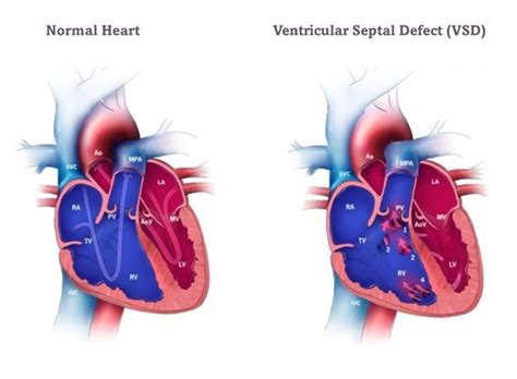 Ventricular Septal Defect Definition Causes Symptoms Vrogue Co
