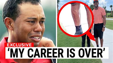 Tiger Woods Fans Are Worried After What They Saw On His Leg Youtube