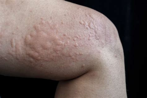 Hives Urticaria Symptoms Causes Diagnosis Treatment
