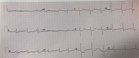 Dr Smiths Ecg Blog St Depression Maximal In V1 V4 And Angio Shows 3