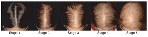 Androgenetic Alopecia New Insights Into The F1000research