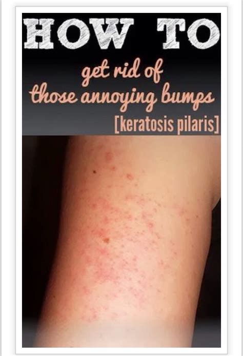 How To Get Rid Of Annoying Bumps Keratosis Pilaris Trusper