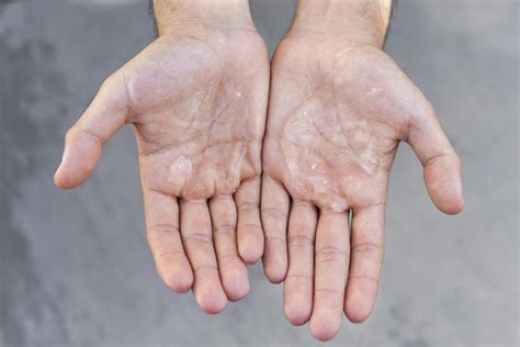 How To Get Rid Of Fungal Infection In Hands Updated 2024 Credihealth