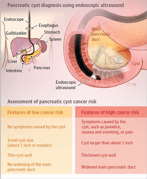 Diagnosis And Treatment Of Pancreatic Cystic Neoplasms Gastroenterology Jama Jama Network