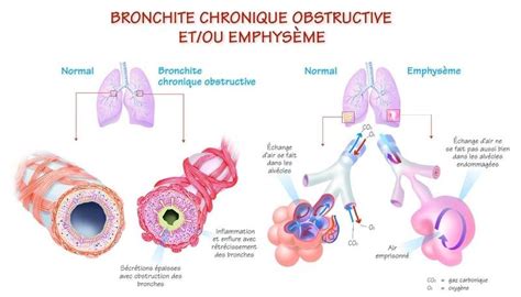 Schématisation De La Bronchite Chronique Et De Lemphysème Image Issue
