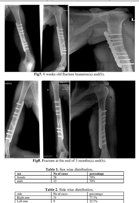 Table 1 From Medial Plating Of Humerus Shaft Fractures Through