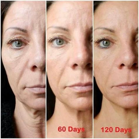Before And After Photos Of Using Neriumad Night Cream Age Shows Not Just From Wrinkles But