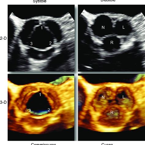 Conventional Echodoppler Measurements In Aortic Stenosis