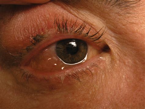 Chemosis After Eyelids Surgery Basic Information And Guidance