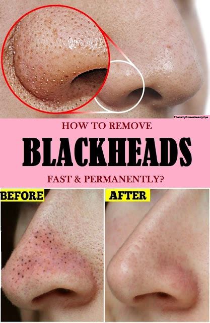 How To Remove Blackheads Fast And Permanently