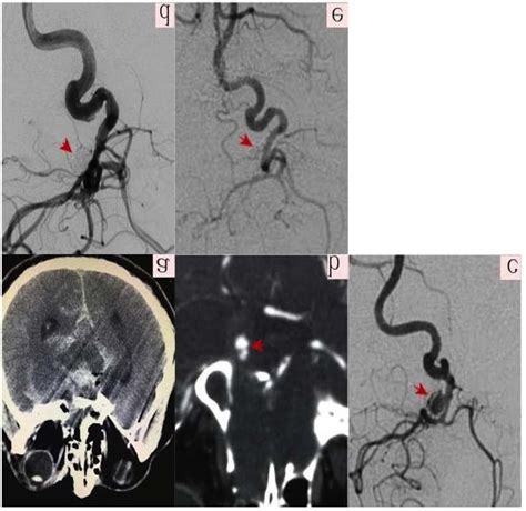 Right Internal Carotid Artery End Dissection Aneurysm Treated With Lvis