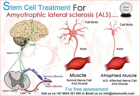 Amyotrophic Lateral Sclerosis ‪‎als‬ Also Known As Lou Gehrigs