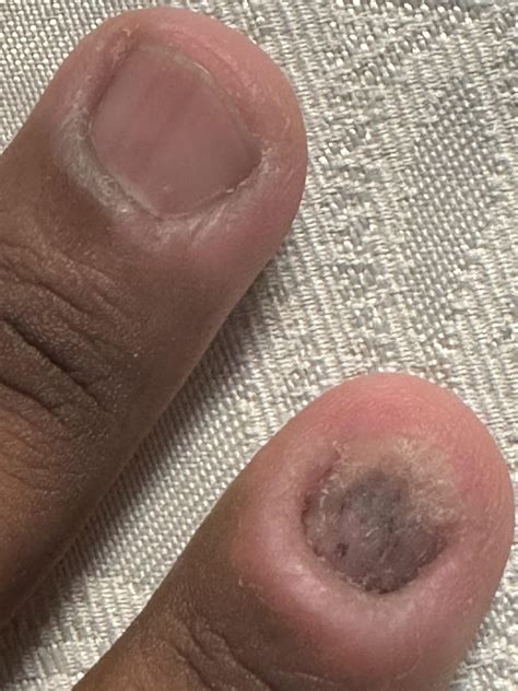 Fingernail Trauma Think Im Done Biting My Nails Rdermatology