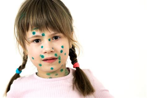 80 Smallpox Rashes On Childrenฃ Stock Photos Pictures And Royalty Free