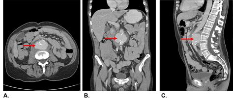 Cureus Mycotic Abdominal Aortic Aneurysm Caused By Streptococcus Equi