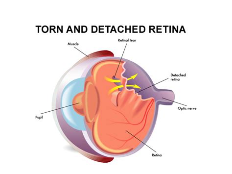 Retinal detachment is a disorder of the eye in which the retina peels away from its underlying layer of support tissue. Torn Retina Symptoms, Causes and How to Treat It