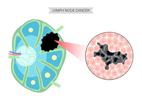 Premium Vector Lymphoma Cancer Concept