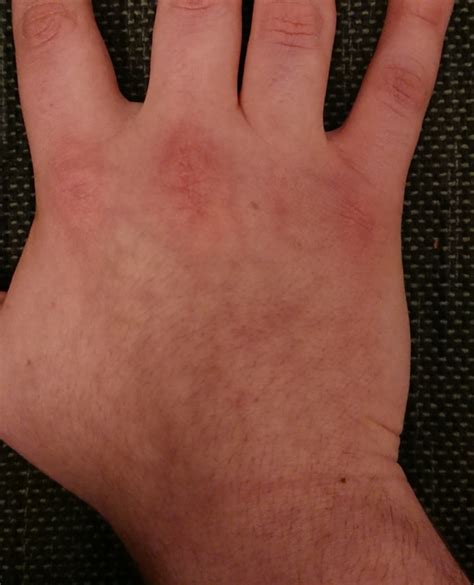 What Causes Red Rash On Back Of Hands