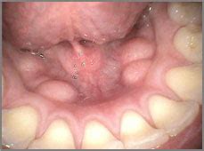 White Spot On Floor Of Mouth Under Tongue Viewfloor Co