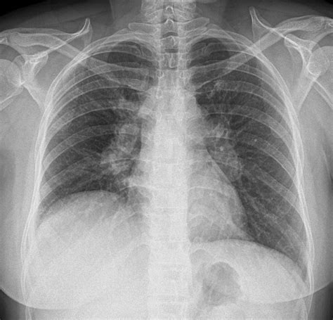 Tuberculous Mediastinal Lymphadenopathy In An Adult Bmj Case Reports