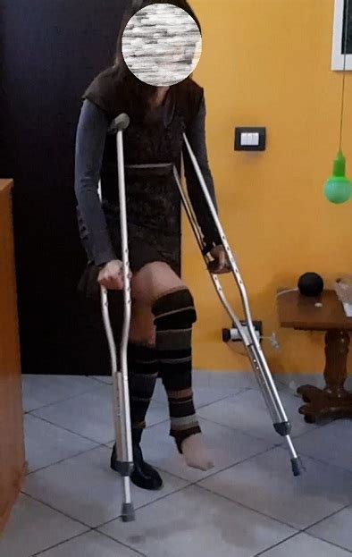 Italian Legcast Crutching Wheelchair Sprain Casts Braces Sprain