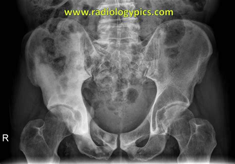 Maybe you would like to learn more about one of these? 15 Reliable Sources To Learn About Tumor Metastasized ...