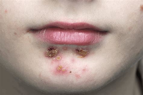 School Sores Treatment Prevention And Causes