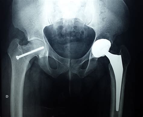 Artroplastia De Quadril Cid