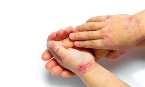 Prise En Charge De La Dermatite Atopique De Lenfant Réalités