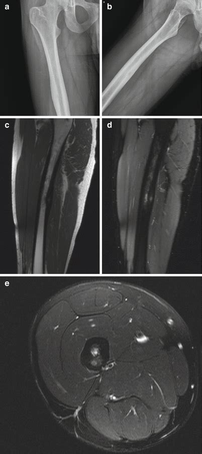 An Imaging Approach To Bone Tumors Musculoskeletal Key