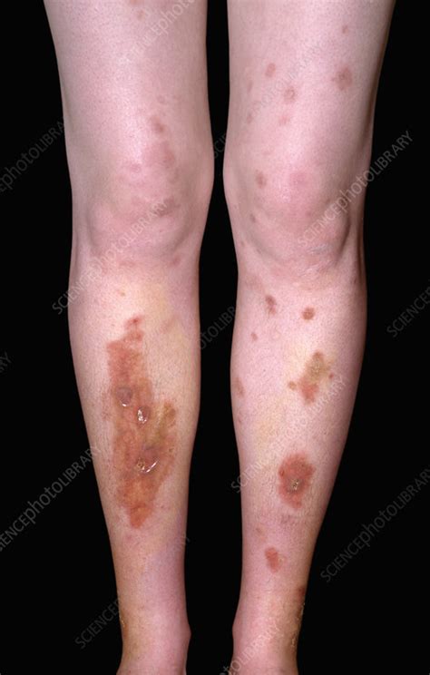 Diabetic Skin Lesions Stock Image C0494451 Science Photo Library