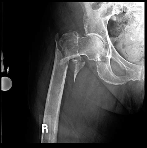 Intertrochanteric Fracture Xray