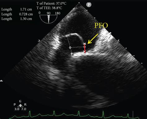 Tee Detection Of A Pfo A The Left Pfo Height And Pfo Tunnel Length