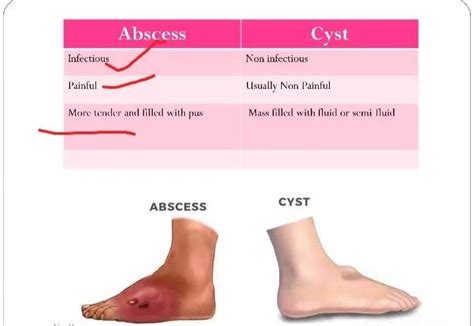 Dr Rajan Patel Difference Bw Cyst And Abscess