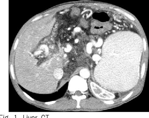 Figure 1 From A Case Report Of Dyspepsia In A Patient With Liver