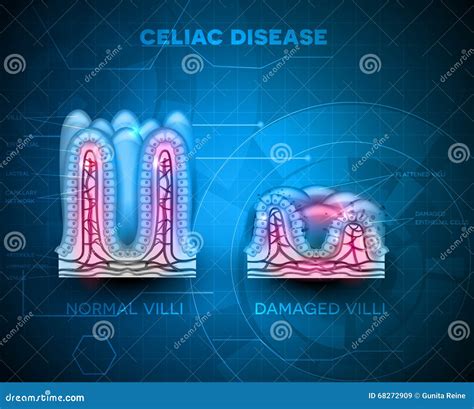 Celiac Disease Stock Vector Illustration Of Autoimmune 68272909