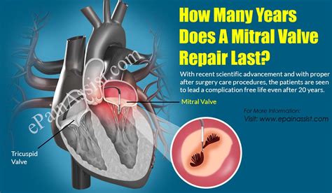 How Long Is Recovery From Aortic Valve Replacement Best Home Design Ideas