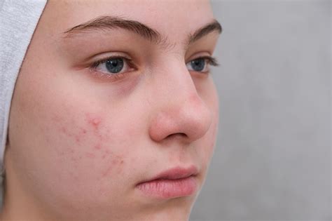 Acne Teenage Girl With The Pimples On Her Face Problematic Skin Closeup