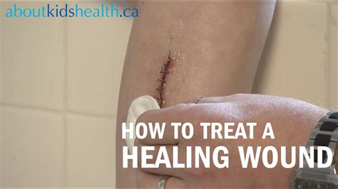 How To Care For A Healing Wound Youtube