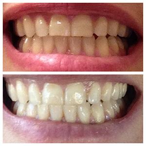 Maybe you would like to learn more about one of these? Top 10 Best Teeth Whitening Mouthwash of 2018 - Reviews