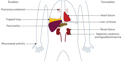 Pleural effusions and atelectasis are also common in the coronary care setting. The management of benign non-infective pleural effusions ...