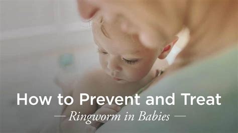 How To Get Rid Of Ringworm On Baby Face Mang Temon