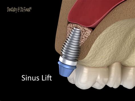 Sinus Lift What Is It Procedure Recovery