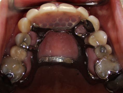 partial dentures plates northland prosthodontics northland