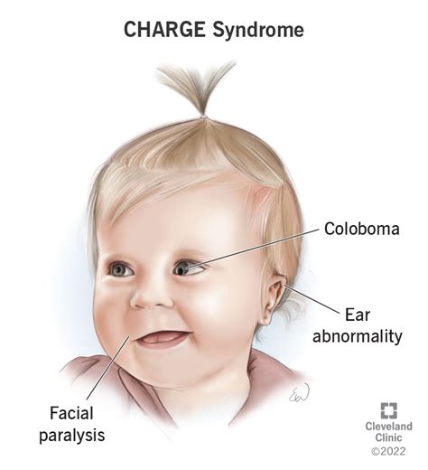 Charge Syndrome Symptoms And Causes