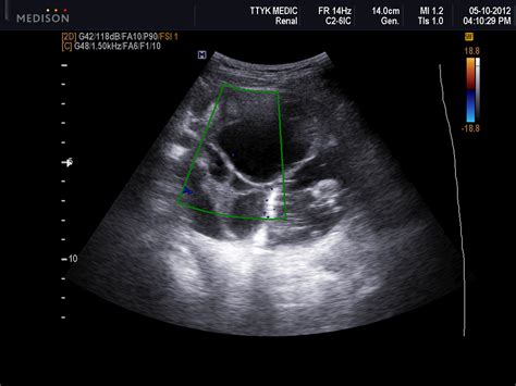It is a genetically heterogeneous multiple imaging modalities have a role in the evaluation of the ovaries, including ultrasound, ct. VIETNAMESE MEDIC ULTRASOUND: CASE 145: MALIGNANT OVARIAN ...