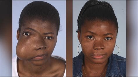 Maxillofacial Surgery Changing Faces Changing Lives Kadiatus Story